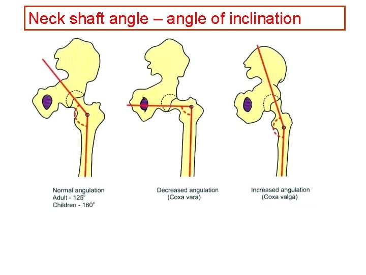 Neck shaft angle – angle of inclination 