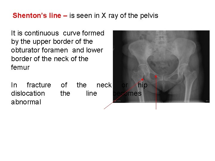 Shenton’s line – is seen in X ray of the pelvis It is continuous