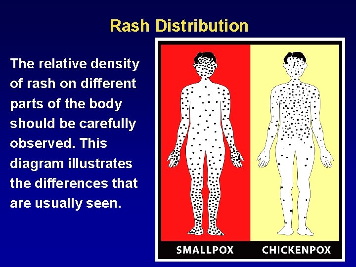 Rash Distribution The relative density of rash on different parts of the body should