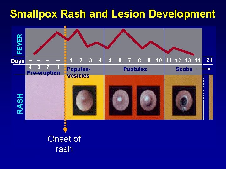 FEVER Smallpox Rash and Lesion Development 1 2 Onset of rash Source: WHO 3