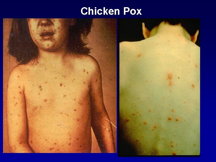 Chicken Pox 