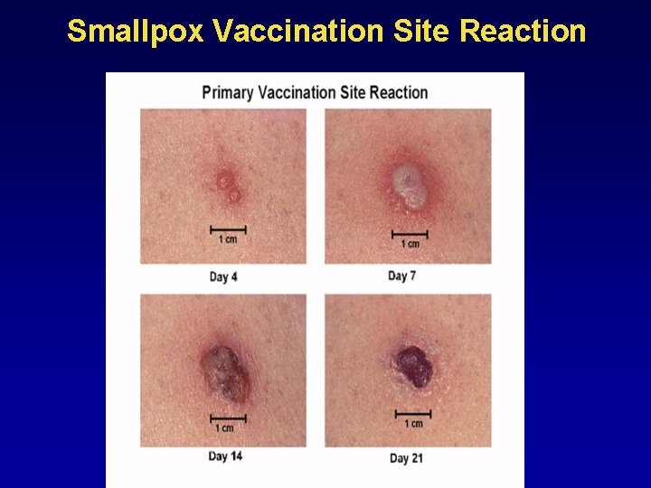 Smallpox Vaccination Site Reaction 