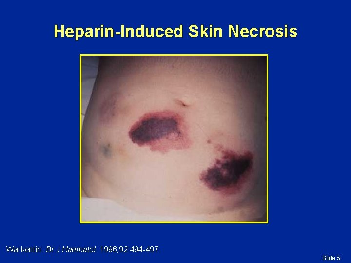 Heparin-Induced Skin Necrosis Warkentin. Br J Haematol. 1996; 92: 494 -497. Slide 5 