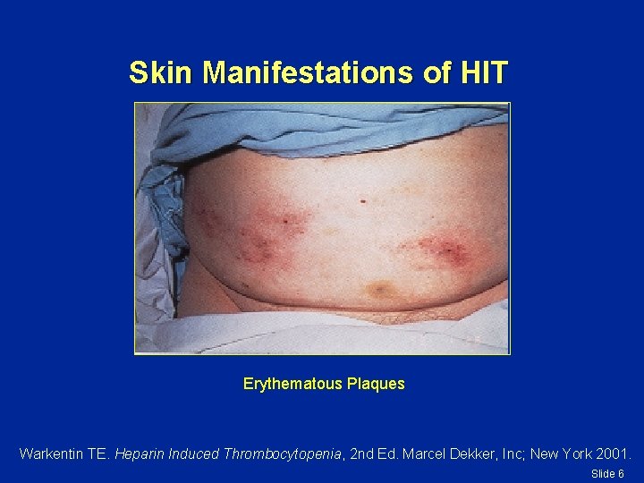 Skin Manifestations of HIT Erythematous Plaques Warkentin TE. Heparin Induced Thrombocytopenia, 2 nd Ed.