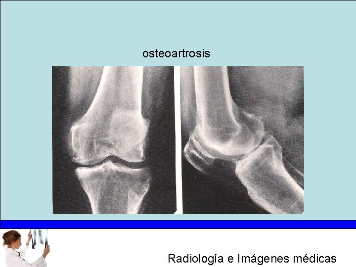 osteoartrosis Radiología e Imágenes médicas 