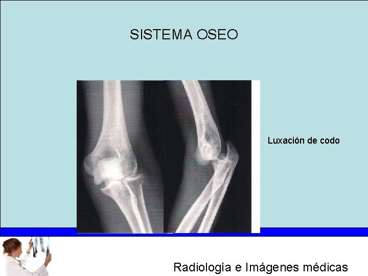 SISTEMA OSEO Luxación de codo Radiología e Imágenes médicas 