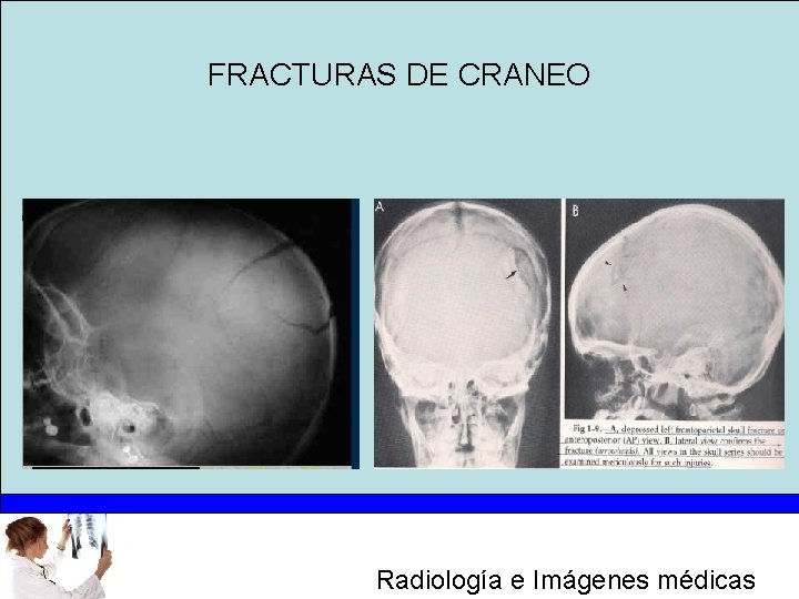 FRACTURAS DE CRANEO Radiología e Imágenes médicas 