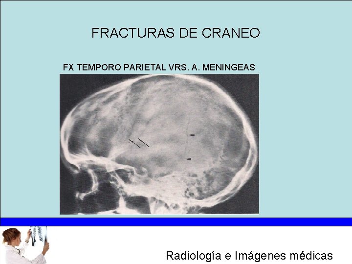 FRACTURAS DE CRANEO FX TEMPORO PARIETAL VRS. A. MENINGEAS Radiología e Imágenes médicas 