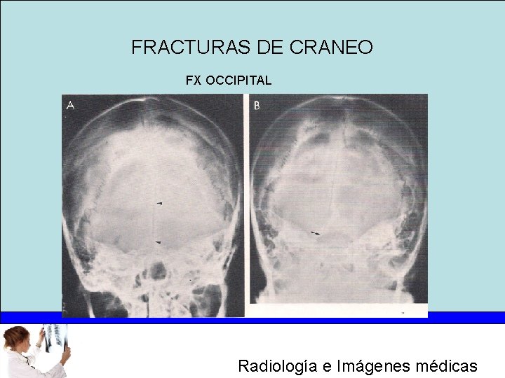 FRACTURAS DE CRANEO FX OCCIPITAL Radiología e Imágenes médicas 