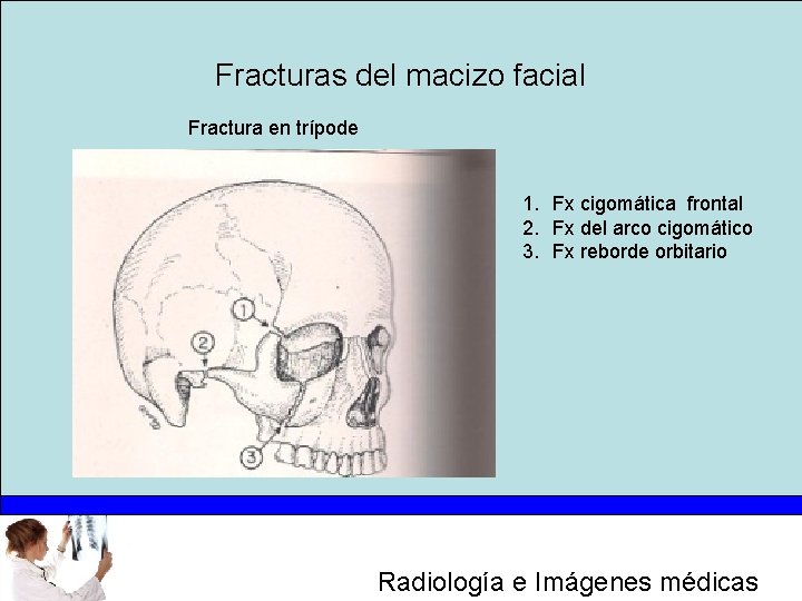 Fracturas del macizo facial Fractura en trípode 1. Fx cigomática frontal 2. Fx del