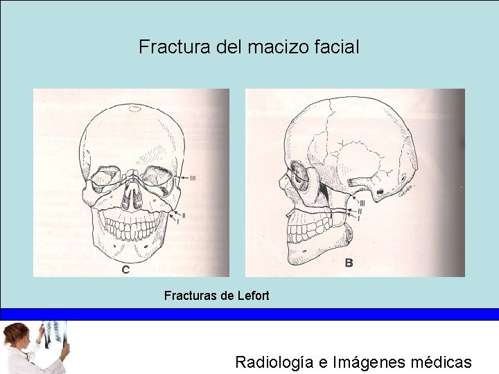 Fractura del macizo facial Fracturas de Lefort Radiología e Imágenes médicas 