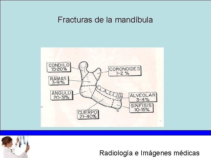 Fracturas de la mandíbula Radiología e Imágenes médicas 