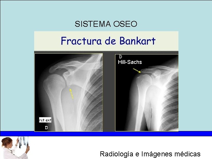 SISTEMA OSEO Hill-Sachs Radiología e Imágenes médicas 