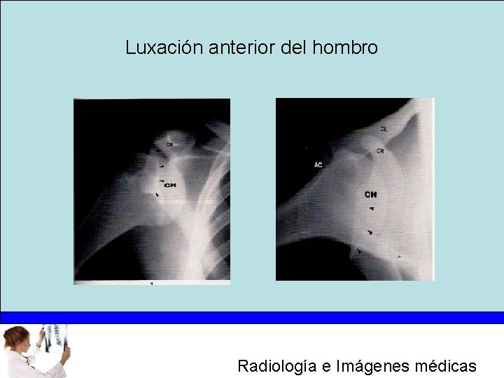 Luxación anterior del hombro Radiología e Imágenes médicas 