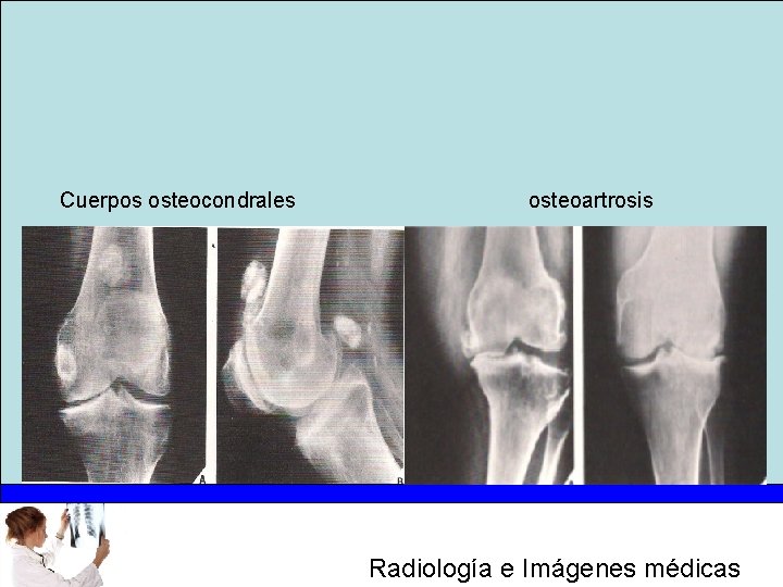 Cuerpos osteocondrales osteoartrosis Radiología e Imágenes médicas 