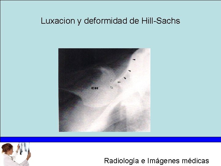 Luxacion y deformidad de Hill-Sachs Radiología e Imágenes médicas 