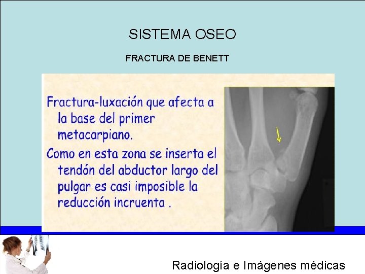 SISTEMA OSEO FRACTURA DE BENETT Radiología e Imágenes médicas 