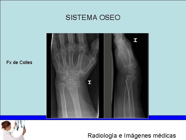 SISTEMA OSEO Fx de Colles Radiología e Imágenes médicas 