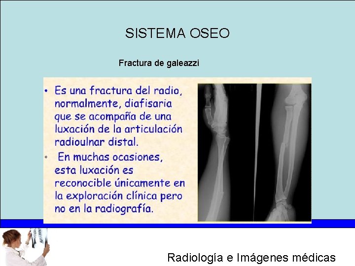 SISTEMA OSEO Fractura de galeazzi Radiología e Imágenes médicas 