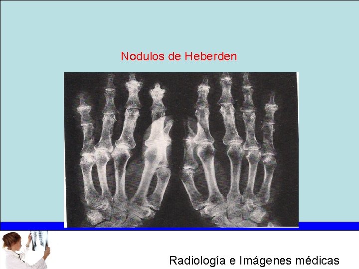 Nodulos de Heberden Radiología e Imágenes médicas 