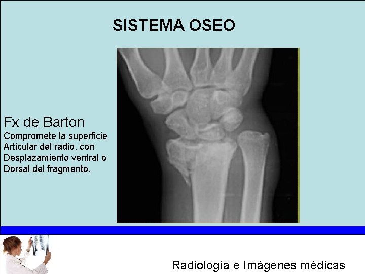 SISTEMA OSEO Fx de Barton Compromete la superficie Articular del radio, con Desplazamiento ventral