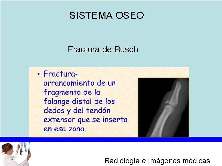 SISTEMA OSEO Fractura de Busch Radiología e Imágenes médicas 