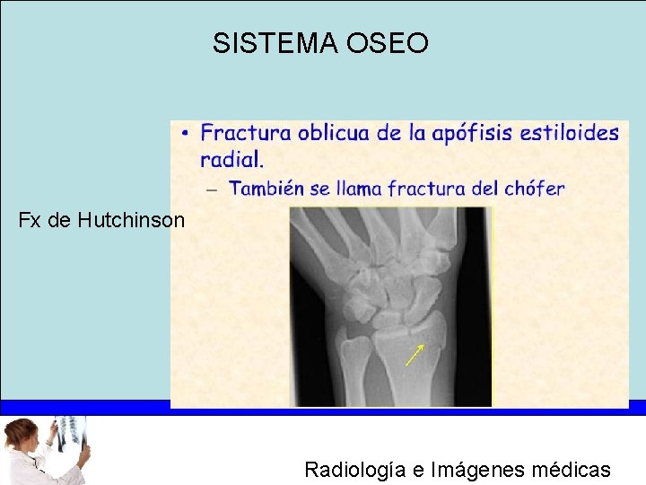 SISTEMA OSEO Fx de Hutchinson Radiología e Imágenes médicas 