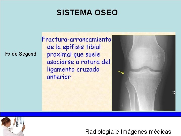 SISTEMA OSEO Fx de Segond Radiología e Imágenes médicas 