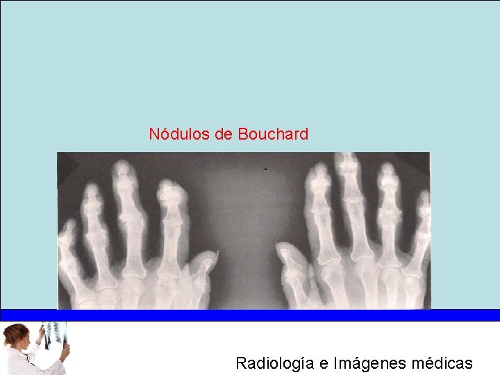 Nódulos de Bouchard Radiología e Imágenes médicas 