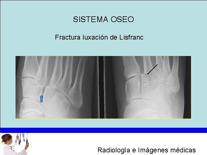 SISTEMA OSEO Fractura luxación de Lisfranc Radiología e Imágenes médicas 