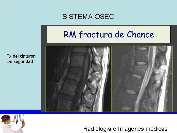 SISTEMA OSEO Fx del cinturon De seguridad Radiología e Imágenes médicas 