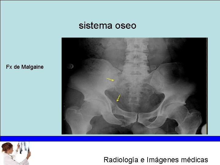 sistema oseo Fx de Malgaine Radiología e Imágenes médicas 