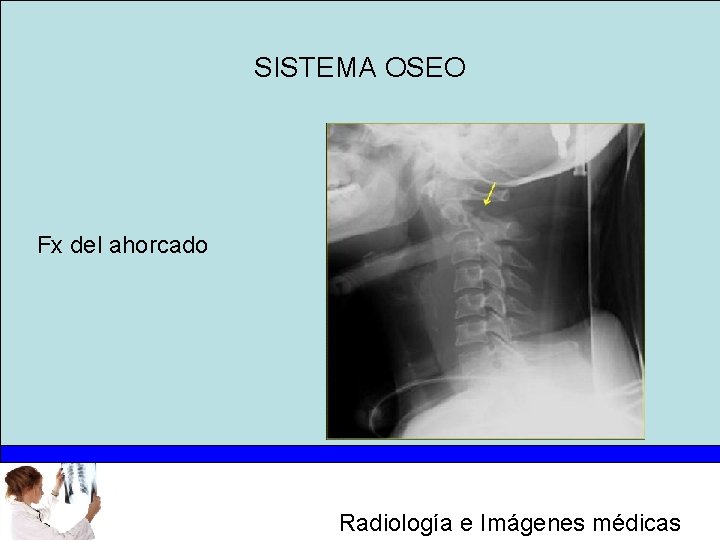 SISTEMA OSEO Fx del ahorcado Radiología e Imágenes médicas 