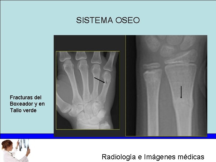 SISTEMA OSEO Fracturas del Boxeador y en Tallo verde Radiología e Imágenes médicas 