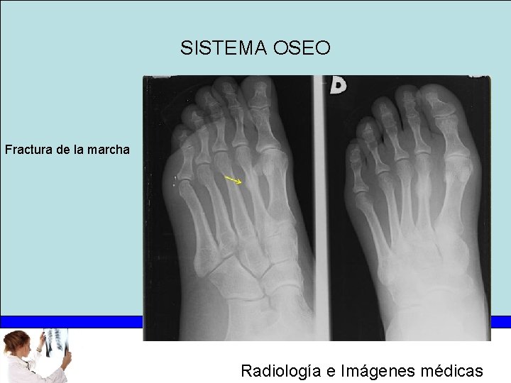 SISTEMA OSEO Fractura de la marcha Radiología e Imágenes médicas 