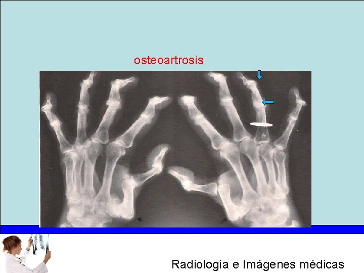 osteoartrosis Radiología e Imágenes médicas 