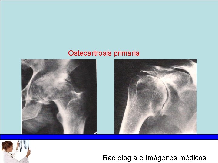 Osteoartrosis primaria Radiología e Imágenes médicas 