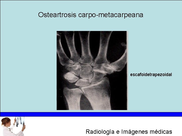 Osteartrosis carpo-metacarpeana escafoidetrapezoidal Radiología e Imágenes médicas 