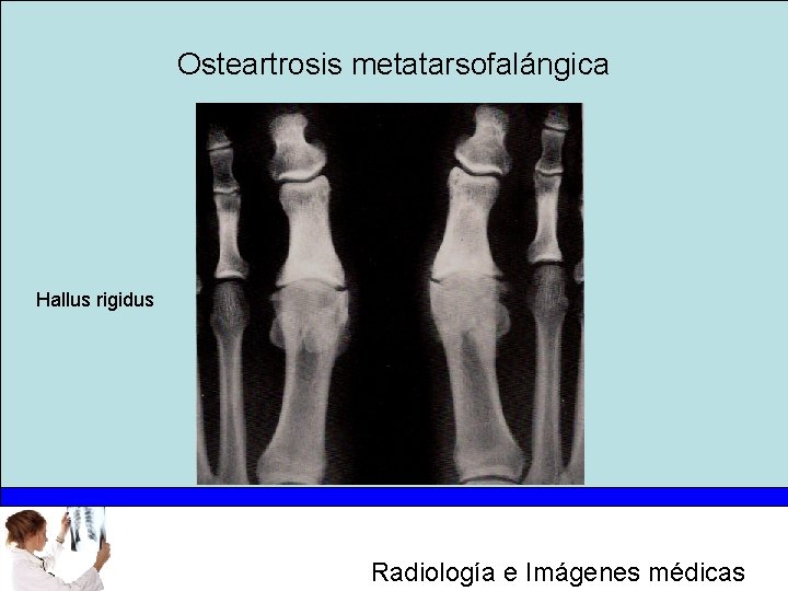 Osteartrosis metatarsofalángica Hallus rigidus Radiología e Imágenes médicas 