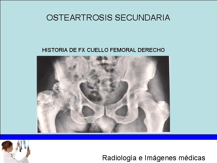 OSTEARTROSIS SECUNDARIA HISTORIA DE FX CUELLO FEMORAL DERECHO Radiología e Imágenes médicas 