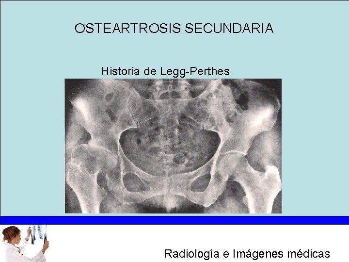 OSTEARTROSIS SECUNDARIA Historia de Legg-Perthes Radiología e Imágenes médicas 