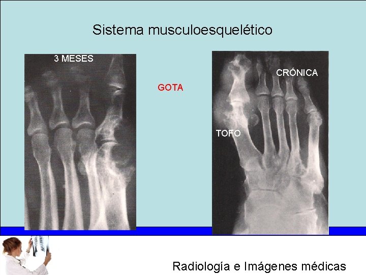 Sistema musculoesquelético 3 MESES CRÓNICA GOTA TOFO Radiología e Imágenes médicas 