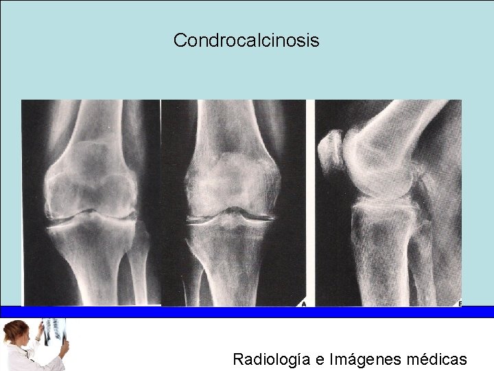 Condrocalcinosis Radiología e Imágenes médicas 