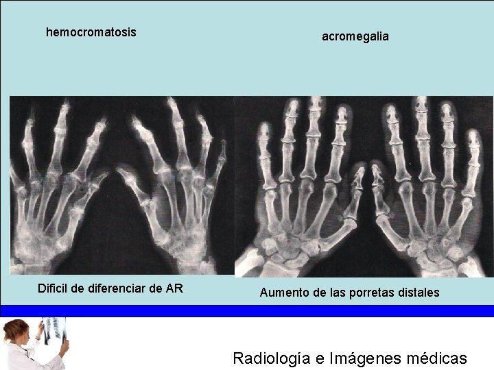 hemocromatosis Dificil de diferenciar de AR acromegalia Aumento de las porretas distales Radiología e