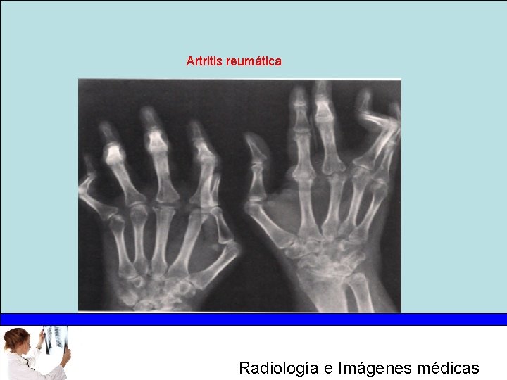 Artritis reumática Radiología e Imágenes médicas 