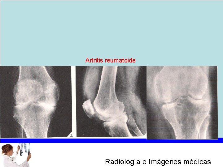 Artritis reumatoide Radiología e Imágenes médicas 