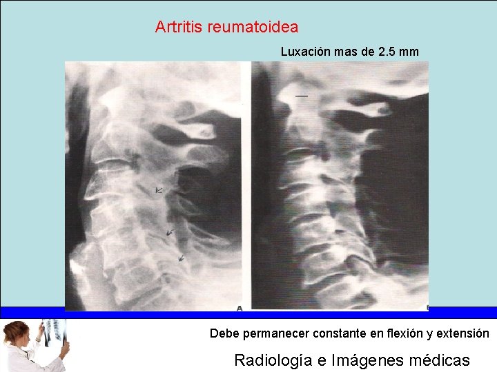 Artritis reumatoidea Luxación mas de 2. 5 mm Debe permanecer constante en flexión y