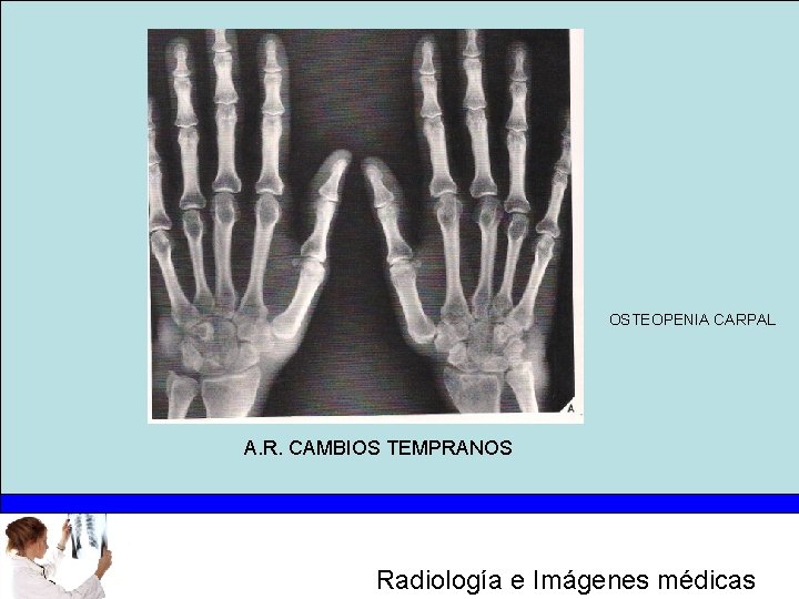 OSTEOPENIA CARPAL A. R. CAMBIOS TEMPRANOS Radiología e Imágenes médicas 