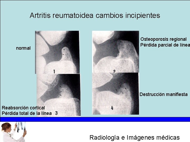 Artritis reumatoidea cambios incipientes normal Osteoporosis regional Pérdida parcial de línea Destrucción manifiesta Reabsorción