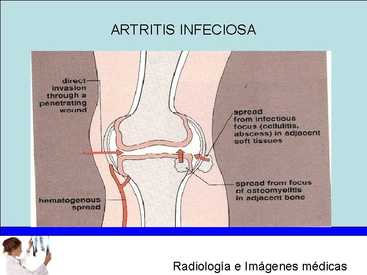 ARTRITIS INFECIOSA Radiología e Imágenes médicas 